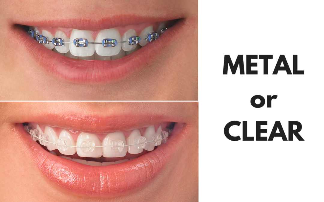 Ask Your Waco or Harker Heights Dentist: Should I Get Metal or Clear Braces?
