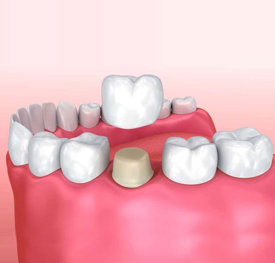 3D Image of Dental Crown to Restore Compromised Teeth