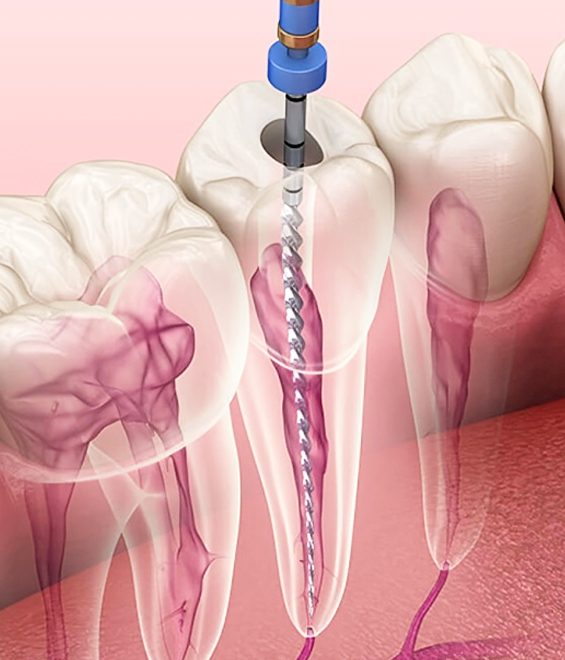 Drilling in tooth for Root canal procedure