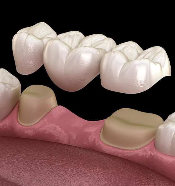 dental bridge placement procedure on missing teeth