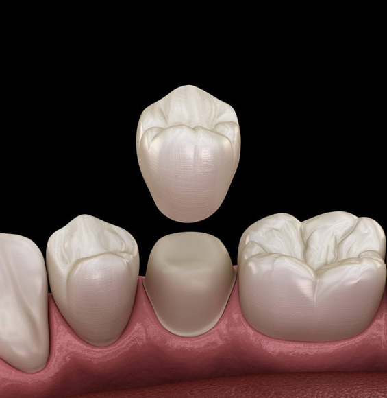 Dental crown and implant restoration showing tooth replacement options with gum tissue model.