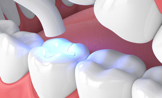 Blue light dental treatment being applied between two teeth in a dental office setting.