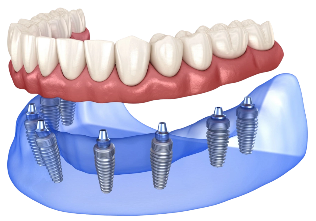 Dental implant prosthetics showing titanium implants anchoring a full arch of replacement teeth in bone.