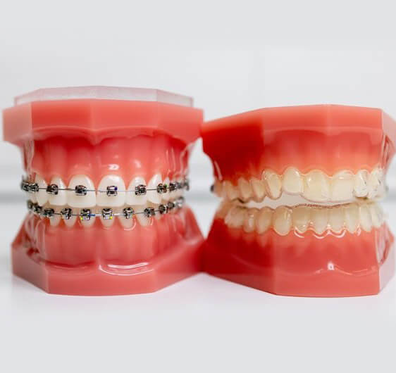 model of aligners and braces in burleson