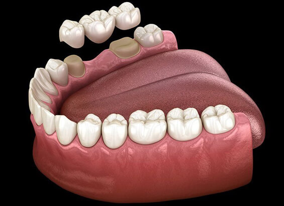 model of dental bridges in burleson