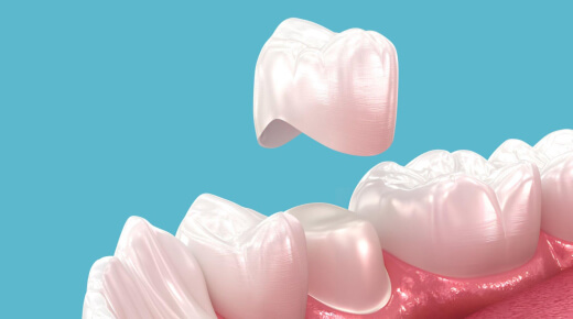 model of dental crowns in burleson