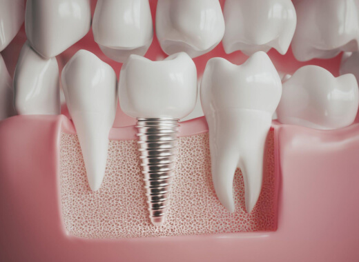 model of dental implants in burleson