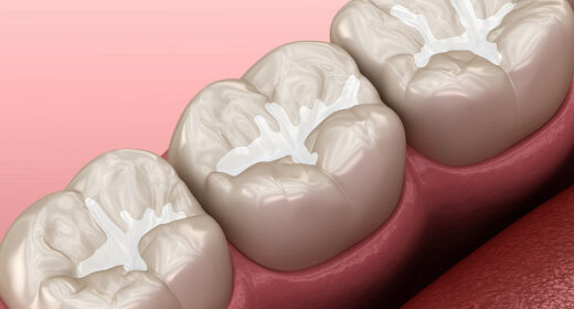 model of dental sealants in burleson