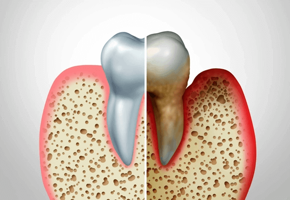 treat gum disease in Burleson