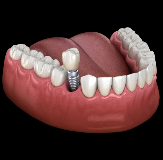 Dental implant illustration showing titanium screw in jawbone with crown attachment and surrounding teeth.